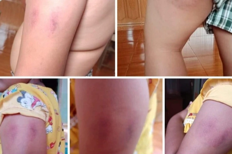Bé gái lớp 1 bị cô giáo đánh vì… không làm xong bài kiểm tra