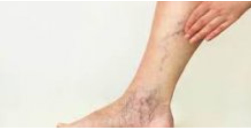 Cô dược sĩ có đôi chân khỏe nhờ kiểm soát được bệnh suy giãn tĩnh mạch